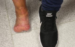 Mark Joiner foot