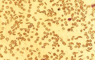A blood film showing classic sickle cells.