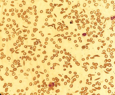 A blood film showing classic sickle cells.